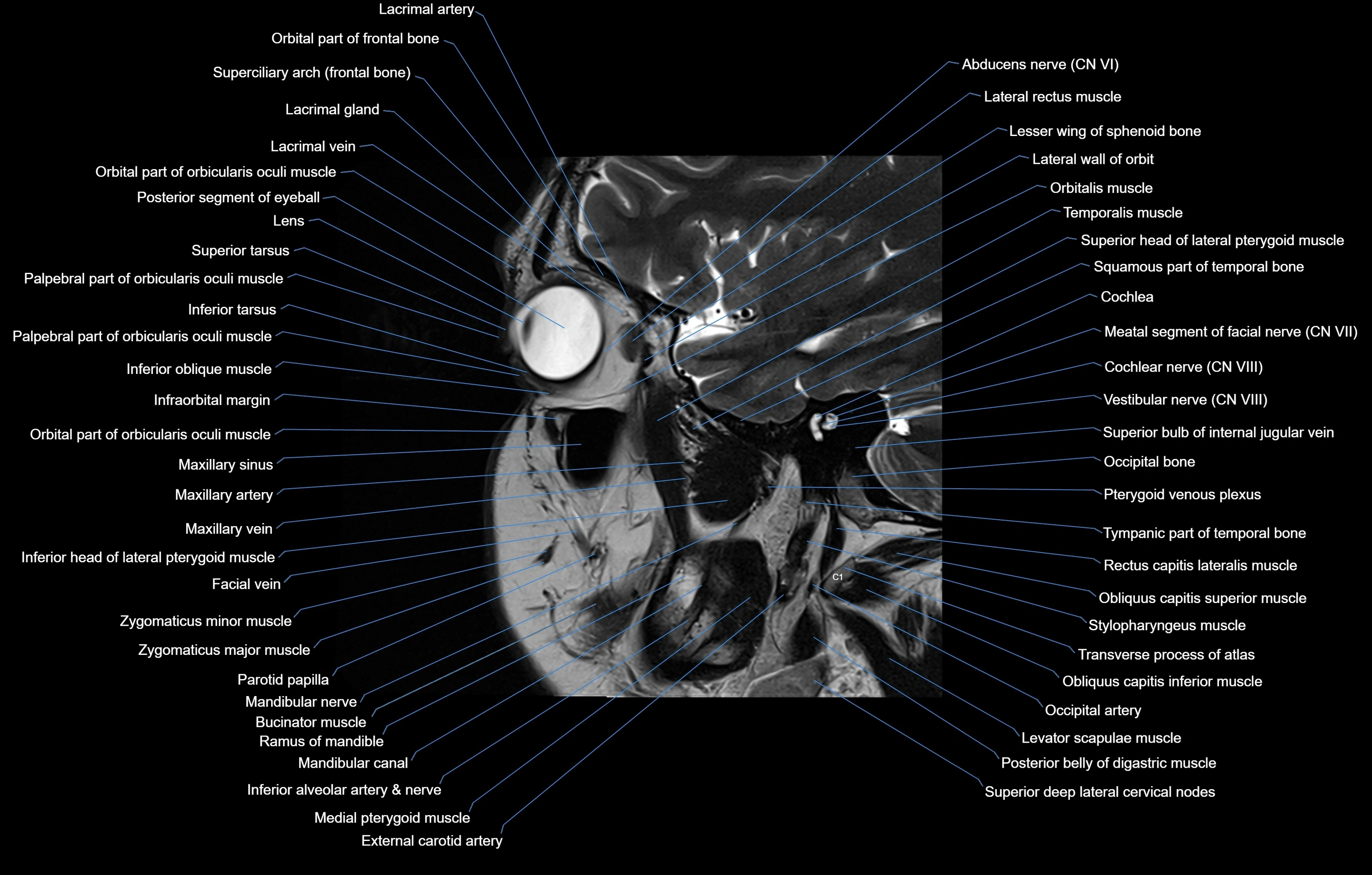 paranasal sinuses(PNS) MRI coronal  cross sectional anatomy 3T radiology  image-img-00001-00015.webp
